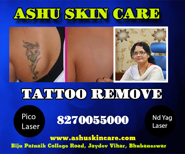 best tattoo remove clinic in bhubaneswar near kims hospital - dr anita rath